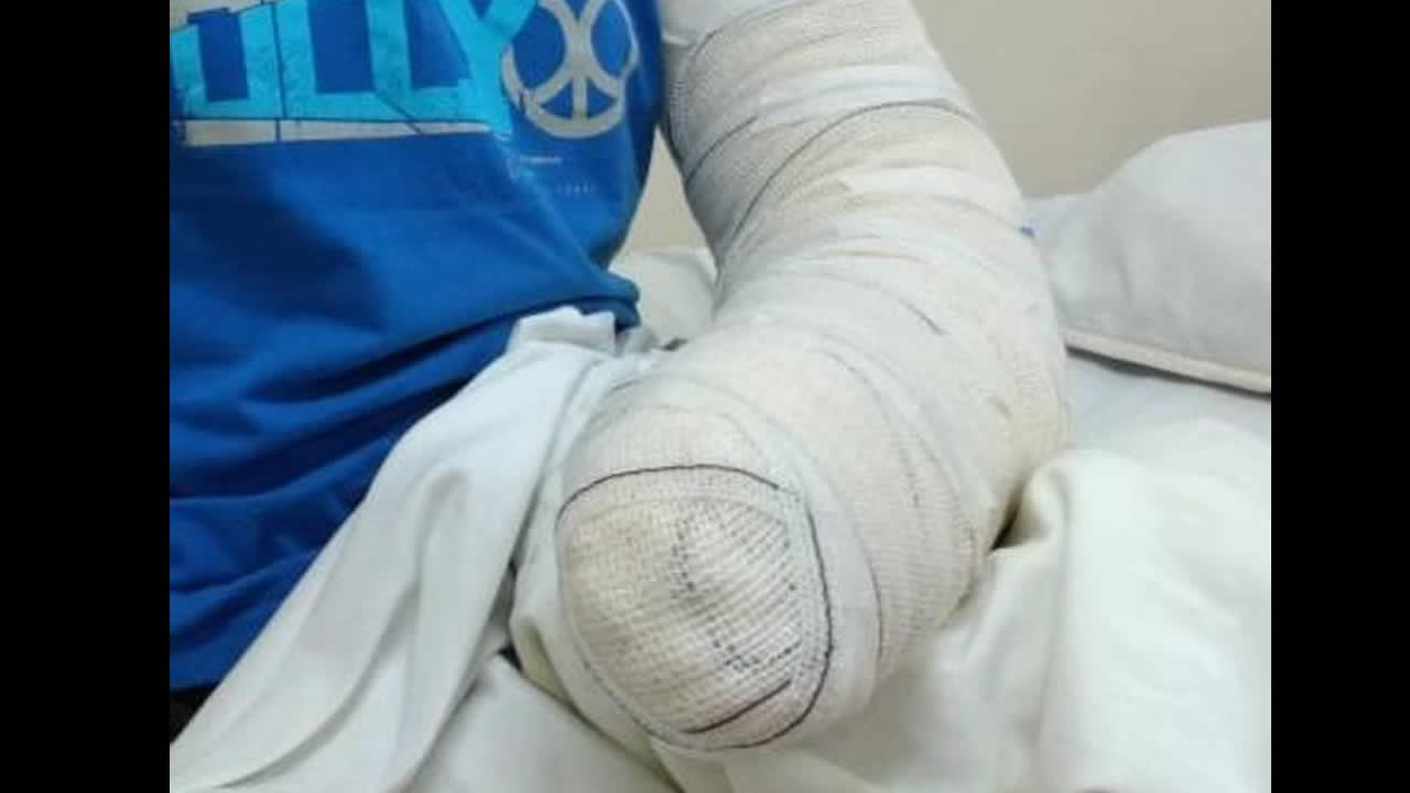 Idoso perde os dedos da mão após picada de aranha 'mega' venenosa em SP 1 Studio Notícias | Studio TV Idoso perde os dedos da mão após picada de aranha 'mega' venenosa em SP