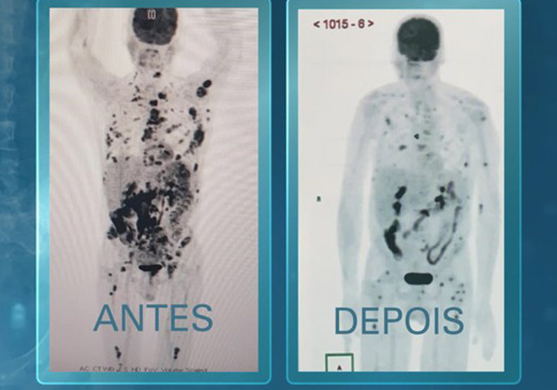 Mais quatro pessoas vão testar terapia que ‘livrou’ paciente terminal do câncer 1 Studio Notícias | Studio TV Mais quatro pessoas vão testar terapia que ‘livrou’ paciente terminal do câncer