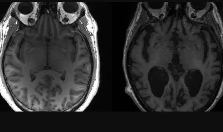 Studio Notícias | Studio TV Alzheimer: pesquisadores identificam 5 subtipos da doença; entenda