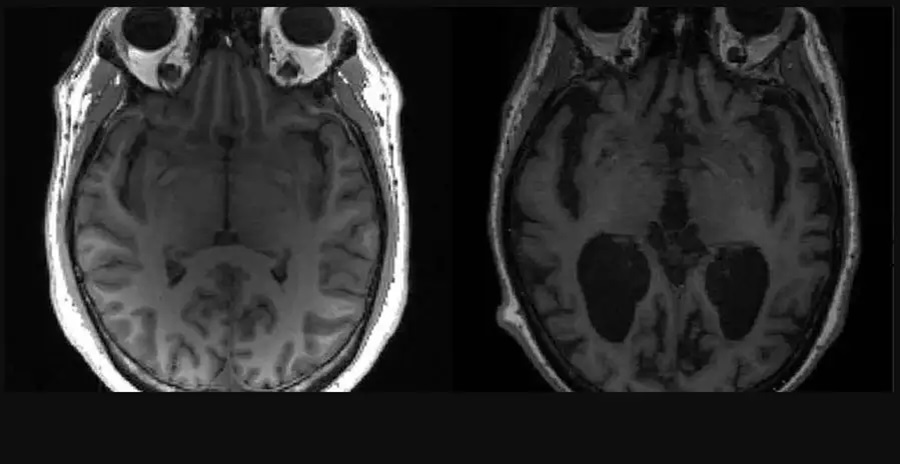 Alzheimer: pesquisadores identificam 5 subtipos da doença; entenda 1 Studio Notícias | Studio TV Alzheimer: pesquisadores identificam 5 subtipos da doença; entenda