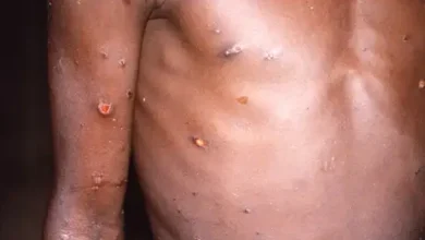 Studio Notícias | Studio TV Região Norte do Brasil registra casos de mpox
