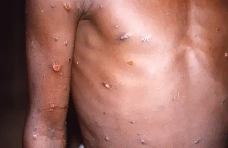 Região Norte do Brasil registra casos de mpox 1 Studio Notícias | Studio TV Região Norte do Brasil registra casos de mpox