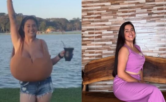Jovem do Paraná reduz 10 kg dos seios após diagnóstico de doença rara 1 Studio Notícias | Studio TV Jovem do Paraná reduz 10 kg dos seios após diagnóstico de doença rara