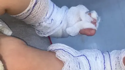 Bebê de 11 meses sofre queimaduras durante banho em escola do RS - Studio TV