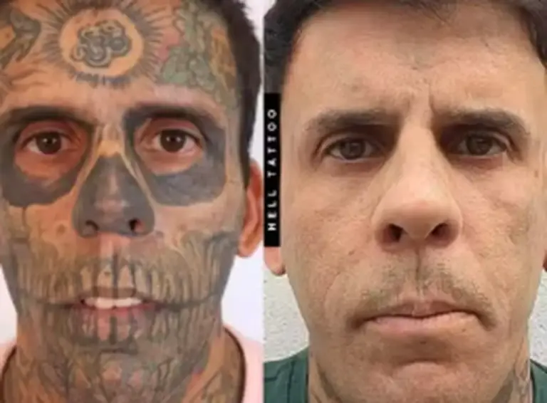 Tumor é descoberto antes de sessão de remoção de tatuagens de gaúcho e procedimento é adiado - Studio TV