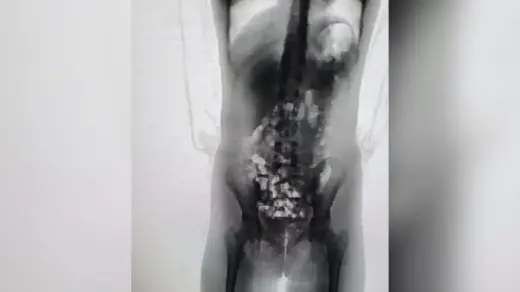 Mãe é presa após scanner identificar 32 porções de droga escondidas no corpo da filha de 13 anos em SC - Studio TV