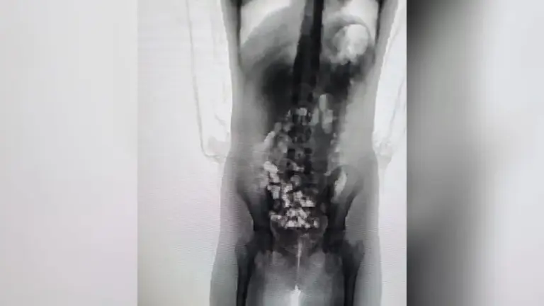 Mãe é presa após scanner identificar 32 porções de droga escondidas no corpo da filha de 13 anos em SC - Studio TV